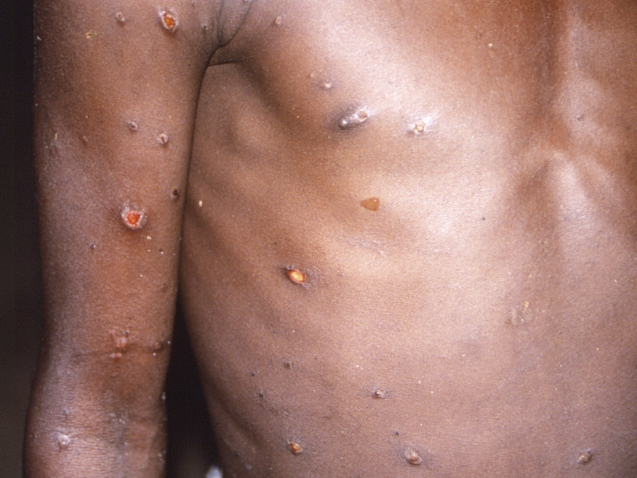 This 1997 image provided by CDC, shows the right arm and torso of a patient, whose skin displayed a number of lesions due to what had been an active case of monkeypox.  As more cases of monkeypox are detected in Europe and North America in 2022, some scientists who have monitored numerous outbreaks in Africa say they are baffled by the unusual disease's spread in developed countries.  (CDC via AP)
