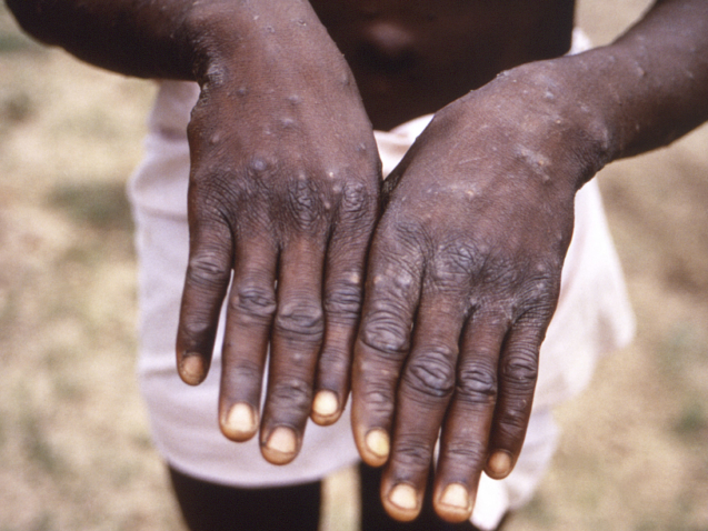 This 1997 image provided by the CDC  during an investigation into an outbreak of monkeypox, which took place in the Democratic Republic of the Congo (DRC), formerly Zaire, and depicts the dorsal surfaces of the hands of a monkeypox case patient, who was displaying the appearance of the characteristic rash during its recuperative stage. As more cases of monkeypox are detected in Europe and North America in 2022, some scientists who have monitored numerous outbreaks in Africa say they are baffled by the unusual disease's spread in developed countries.  (CDC via AP)